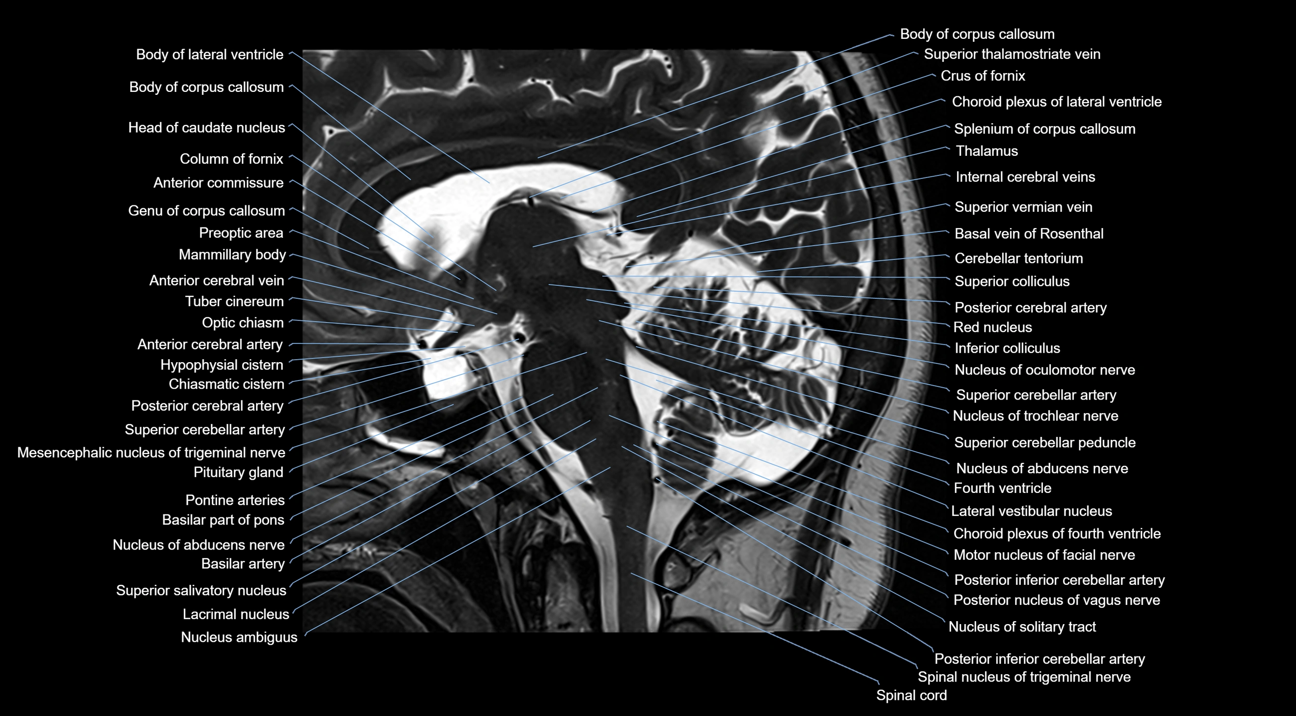 MRI brainstem & basal ganglia anatomy labelled  3T MRI images -img-10001-00022.webp